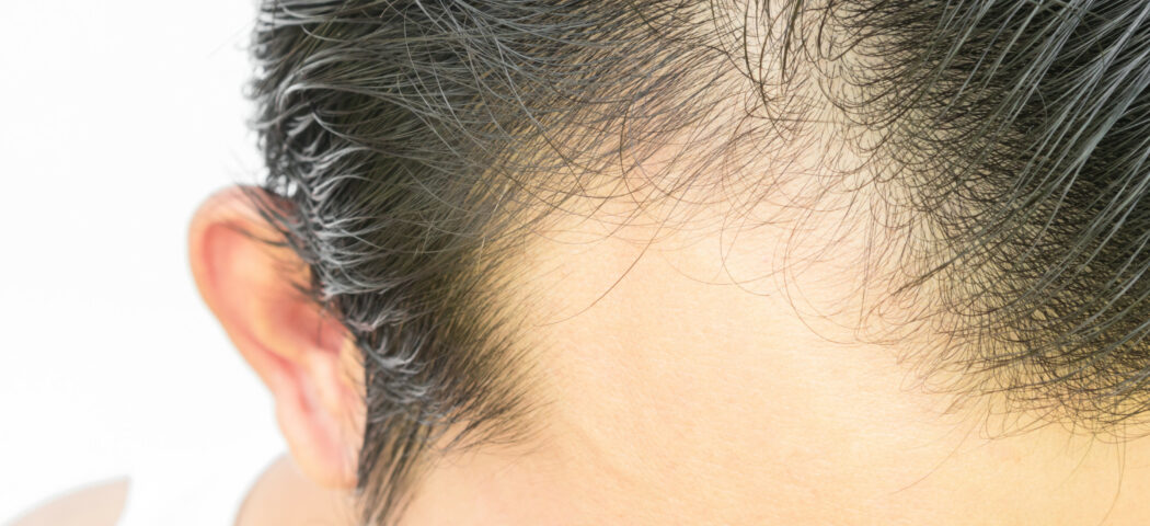 Integratori per contrastare la caduta dei capelli: vitamine e prodotti in farmacia